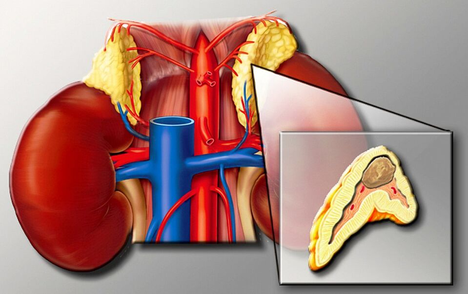Feochromocytoma έναντι υψηλής αρτηριακής πίεσης