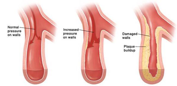 Με υψηλή αρτηριακή πίεση, υπάρχει παραβίαση της βατότητας του αγγειακού κρεβατιού